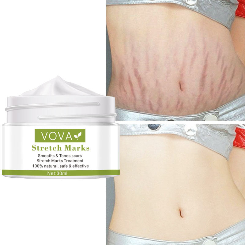 BellySafe™ Stretch Marks Removal