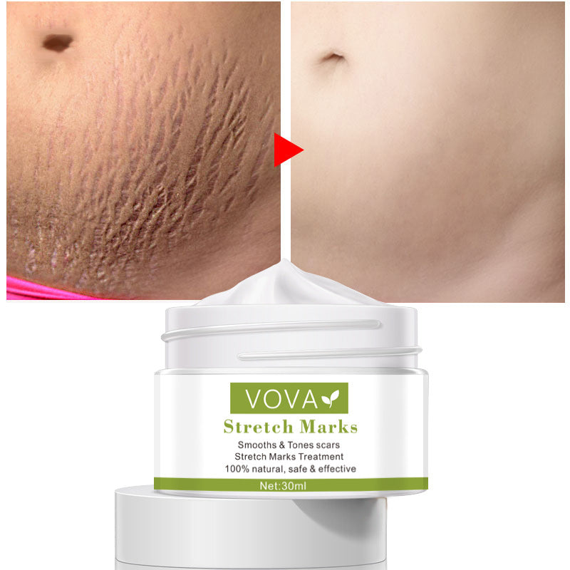 BellySafe™ Stretch Marks Removal