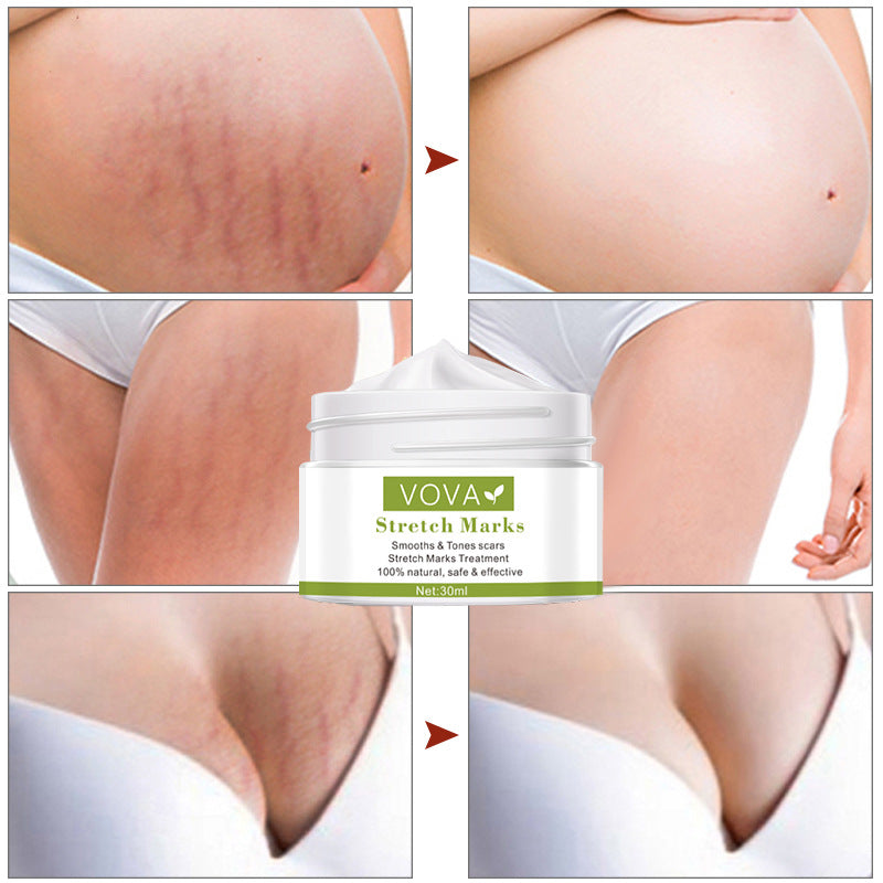 BellySafe™ Stretch Marks Removal